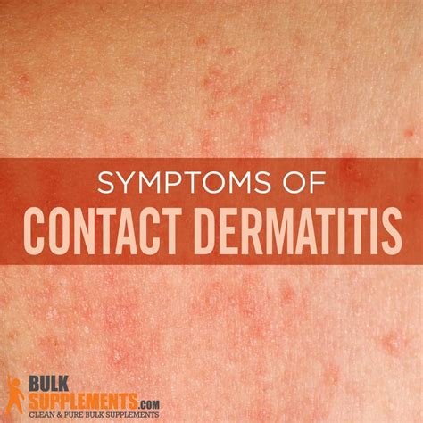 Contact Dermatitis: Symptoms, Causes & Treatment