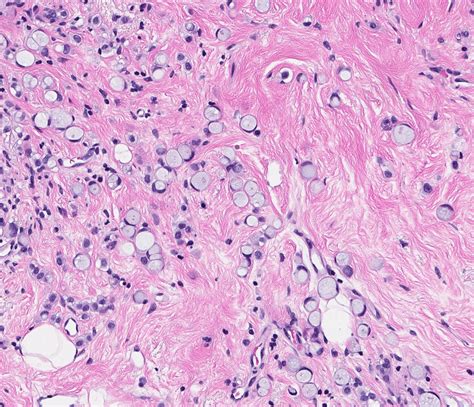 Invasive Ductal Carcinoma Histology