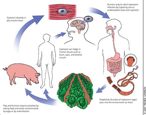 Cysticercosis: An Emerging Parasitic Disease | AAFP