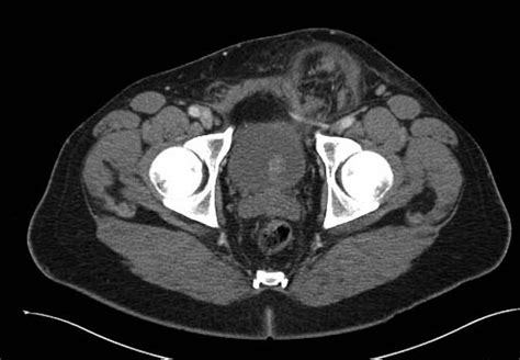 Indirect Inguinal Hernia Ultrasound