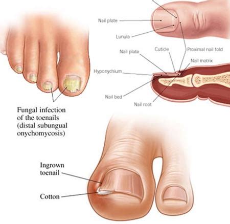 Toenail Fungus Treatment in NYC | Manhattan Foot Specialists