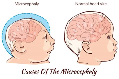 Microcephaly: Causes, Symptoms And Treatment Options | 99 Health Ideas