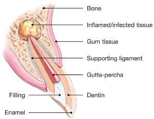 Endodontic Surgery Explained | American Association of Endodontists