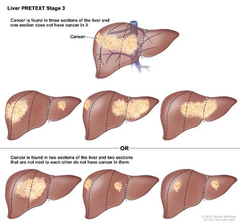 What Are The Four Stages Of Liver Cancer - CancerWalls