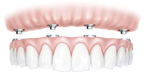 Single Tooth Replacement (Implants) - University Associates in Dentistry