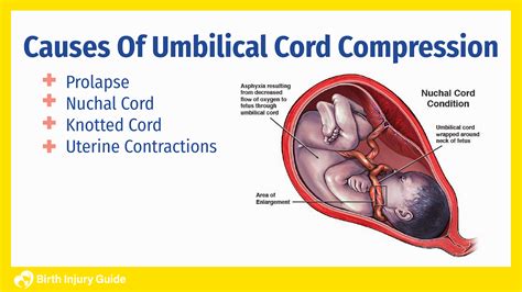 Umbilical Cord Compression and Your Baby's Health | Birth Injury Guide