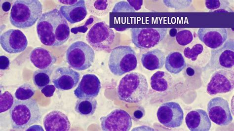 Multiple Myeloma: Symptoms, Causes, Diagnosis and Treatment | KnowInsiders