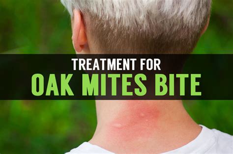 Oak Mites Treatment and Signs of Mite Bites