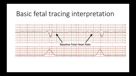 Interpreting Intrapartal fetal heart rate tracings - YouTube