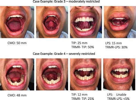 Assessment Of Posterior Tongue Mobility Using, 47% OFF