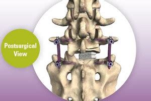 Learning Library: What is the MAS® TLIF procedure, and is it right for me? | The Better Way Back