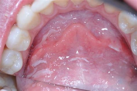 Mouth Cancer Signs and Symptoms | IYTmed.com