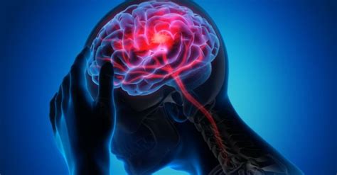 Cerebral Infarction- Causes, Symptoms and Treatment - Apollo Hospitals Blog