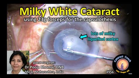 guest surgeon milky white cataract surgery - YouTube