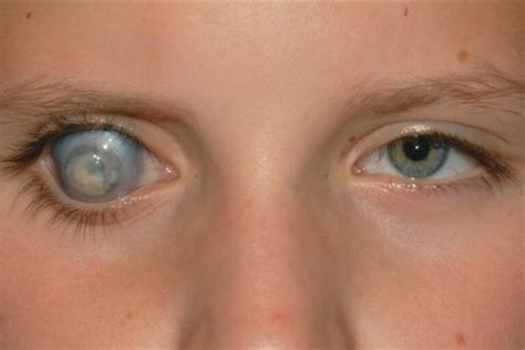 Enucleation and Evisceration: Eye Removal Surgery - The Eye News