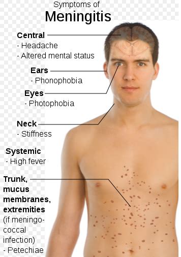 Yale: Silliman College freshman confirmed with meningococcal meningitis B - Outbreak News Today