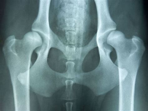 Congenital Hip Dislocation: Causes, Symptoms, and Diagnosis