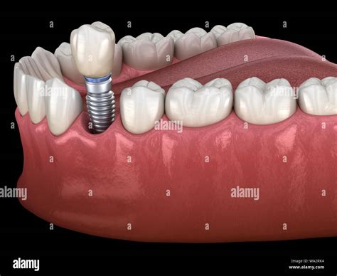 Premolar tooth crown installation over implant abutment. Medically ...