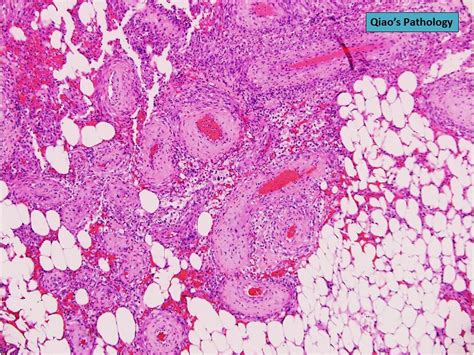 Qiao's Pathology: Classic Renal Angiomyolipoma - a photo on Flickriver