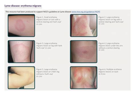 Lyme Disease UK - Lyme Disease and the EM Rash