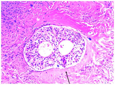 Computed tomography imaging features of benign ovarian Brenner tumors