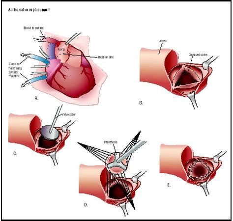 Aortic Valve Replacement - procedure, blood, complications, adults ...