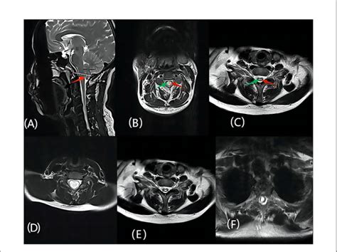 FIGURE E (A) The red arrow represents the herniated cerebellar tonsil ...