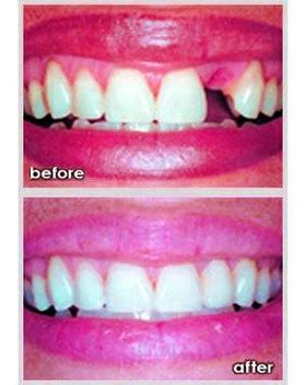 Dental Bridge Before After Photos Image - Graph Diagram