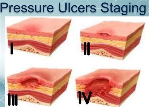 Pressure Ulcer Staging https://www.woundtx.com/ #woundtx Pressure Ulcer Staging, First Aid Tips ...