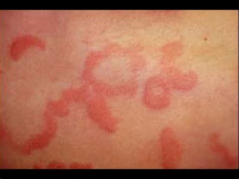 what causes chronic urticaria - is chronic urticaria curable - YouTube