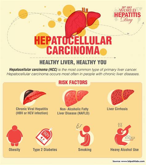 Ppt Hepatocellular Carcinoma Causes Symptoms Daignosi - vrogue.co