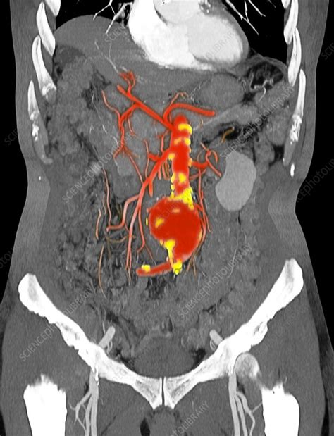 Ct Scan Image Showing An Abdominal Aortic Aneurysm Stock Photo Alamy | Hot Sex Picture