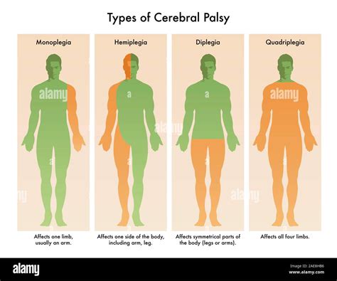 Forms of Cerebral Palsy illustrated in medical diagram Stock Photo - Alamy