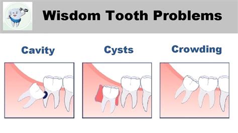 WISDOM TEETH COMPLICATIONS if not removed - YouTube