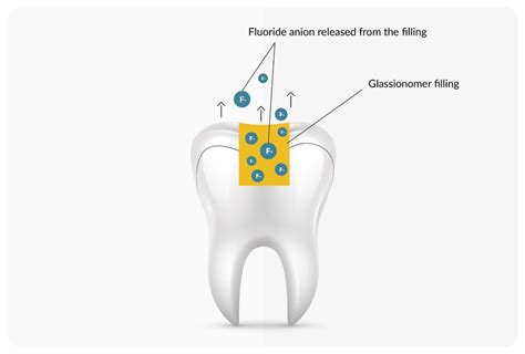 A scheme of a tooth with a filling containing fluoride ions that are ...