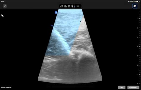 Butterfly Ultrasound - EquiManagement