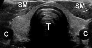 Normal Thyroid Ultrasound