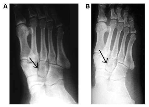 Cuneiform Bone Fracture