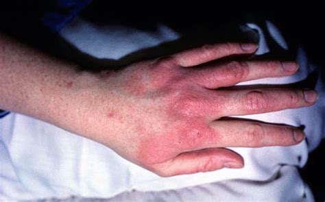 Mild Contact Dermatitis