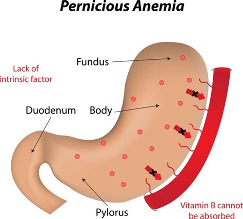 106 imágenes, fotos de stock, objetos en 3D y vectores sobre Anemia ...