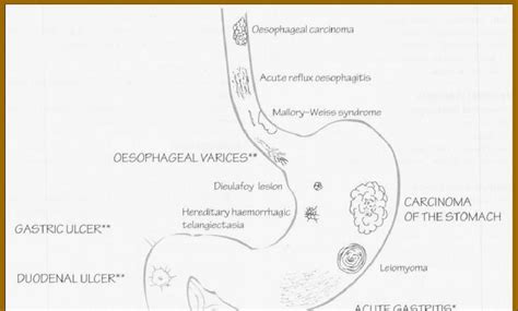 Discovery of Heart: Causes of Haematemesis (Vomiting of Blood)