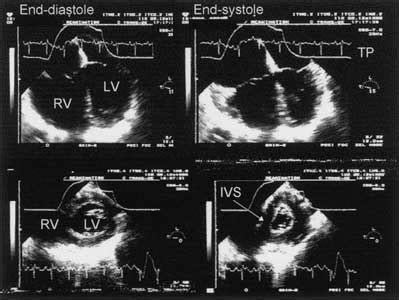 The MUGA scan’s role in monitoring cancer therapy