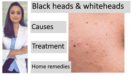 How to remove blackheads & whiteheads| Causes |Treatment | Home ...