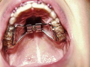 5 Common Questions About Palate Expanders | Thomas Orthodontics