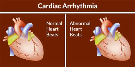 #Cardiac #Arrhythmia #Consultation Arrhythmis are usually found during a routine examination. If ...