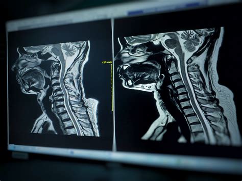 Patients With No Prior RA, Pannus on Cervical Spine MRI Unlikely to Have RA - Rheumatology Advisor