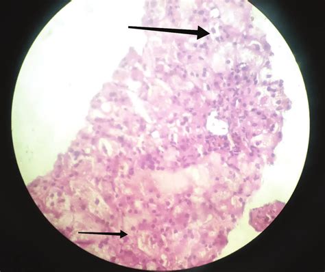 Liver biopsy showing a) ballooning of hepatocytes (top arrow) with b)... | Download Scientific ...