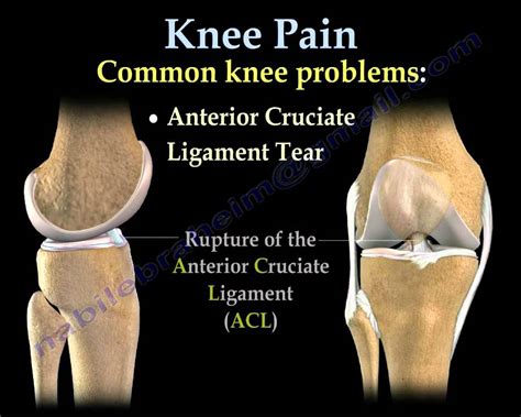 Inner Knee Pain Causes | Minimalis