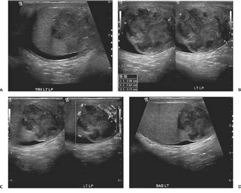 149 Tuberculous Epididymo-Orchitis | Radiology Key