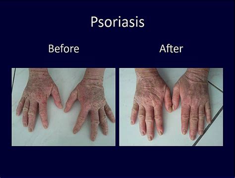 Psoriasis before and after photos | Psoriasis, Giving, Pandora screenshot